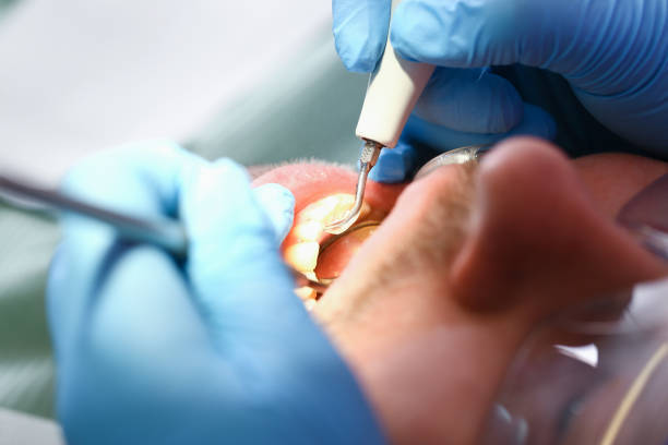 Best Emergency Tooth Extraction in South Gull Lake, MI