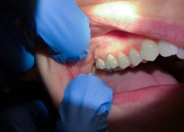 Best Emergency Wisdom Teeth Removal in South Gull Lake, MI