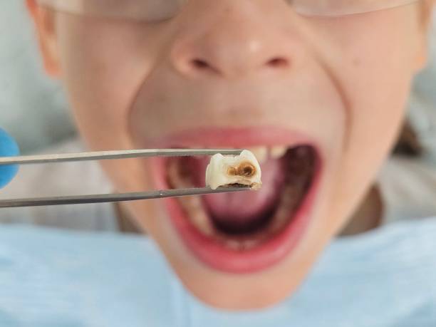 Best Emergency Tooth Extraction in South Gull Lake, MI